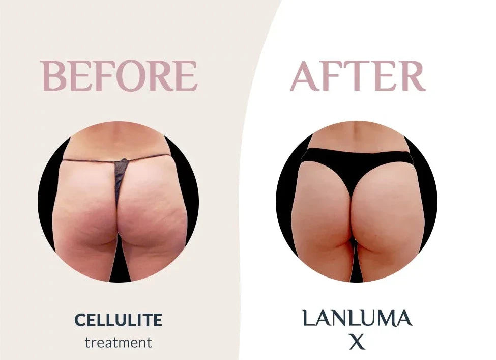 LANLUMA® (Poly-L-lactic acid) - SKINFUDGE® - Center of Skin & Hair Excellence 